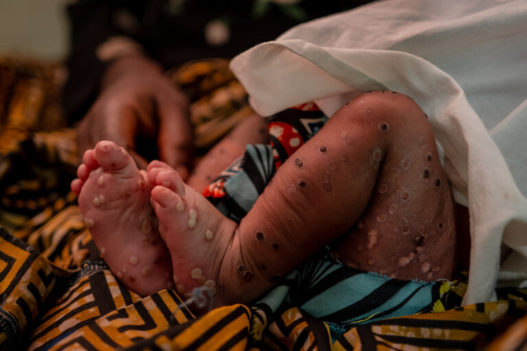 Mpox Outbreak Spreads to 63 LGAs, Cross River, Lagos Worst Hit