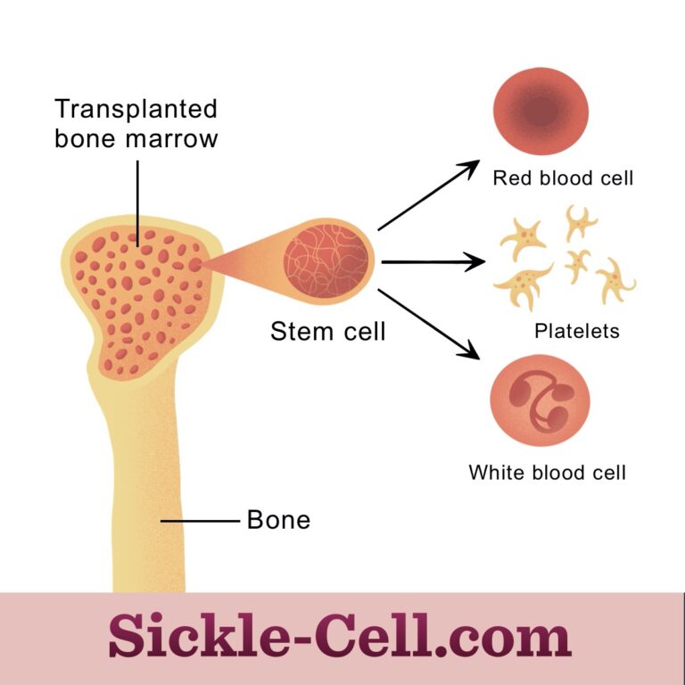 Historic Breakthrough: Nigeria Records First Successful Bone Marrow Transplant for Sickle Cell Disease